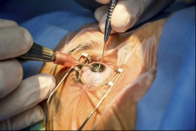 Cirurgias refrativas s